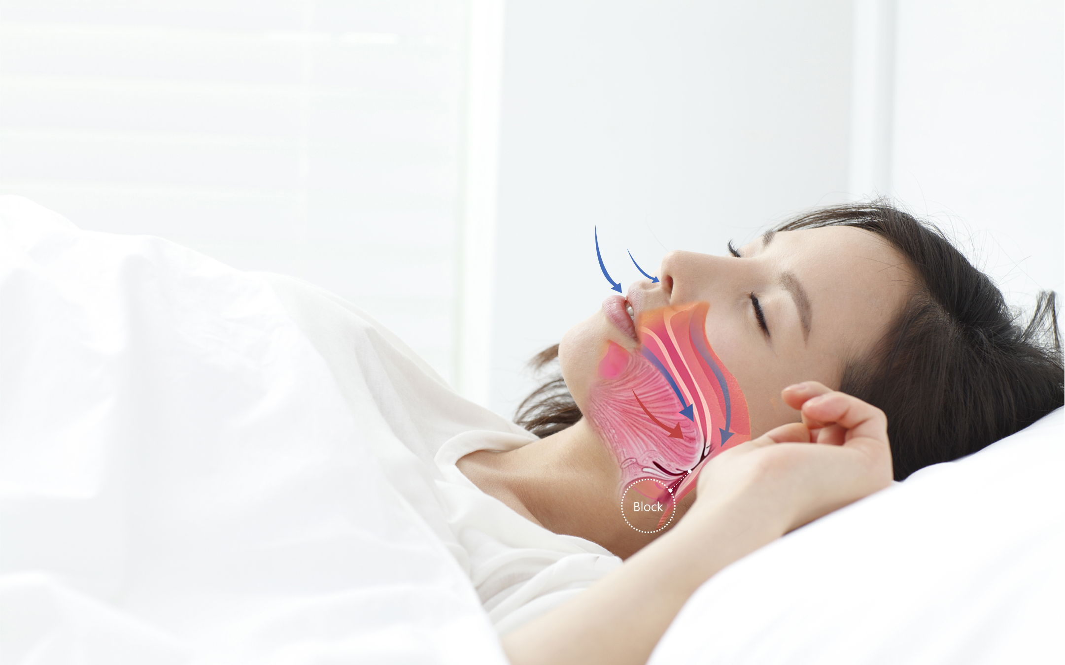 Obstructive sleep apnea causes laxity of the linguistic muscles of the pharynx, resulting in poor or blocked breathing while lying down during sleep, so patients will wake up due to lack of oxygen in the brain for many years.